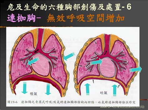 三胸二塞一氣傷|胸外科學/胸部創傷